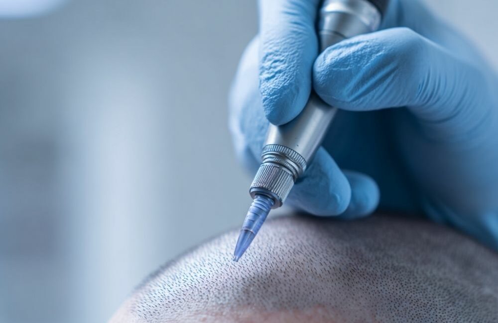 Haarpigmentierung Hannover für Männer und Frauen